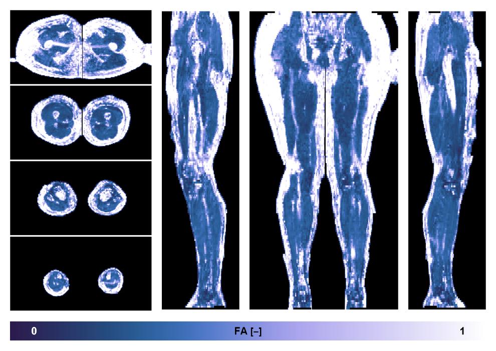 IVIM corrected whole leg muscle fractional anisotropy obtained from diffusion tensor imaging.